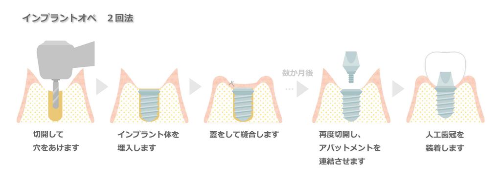 インプラントオペ